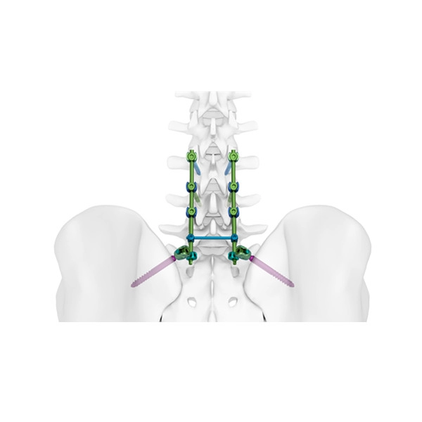 Sistema TINA Spine 5.5/6.0