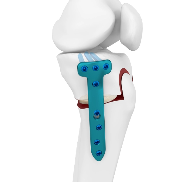 Placa de Bloqueio de Osteotomia Tibial Proximal Medial