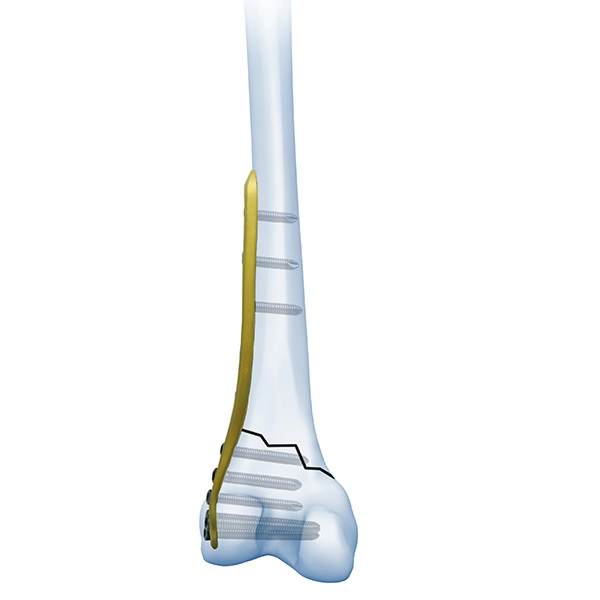 Placa de Bloqueio Femoral Distal Ⅱ