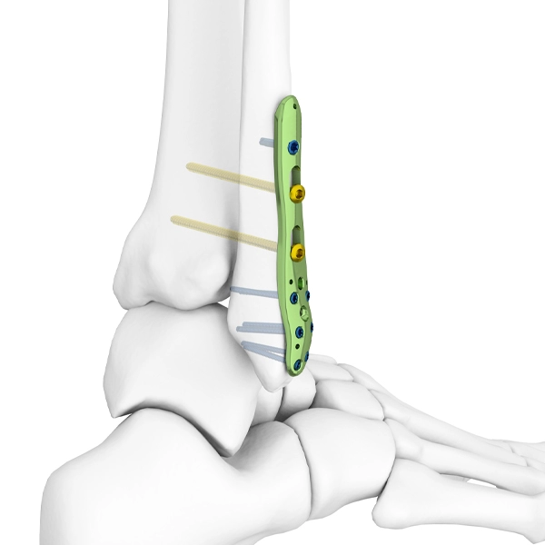 Placa de bloqueio fibular lateral distal